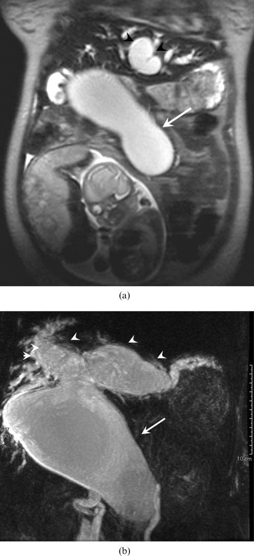A Oto, R Ernst, L Ghulmiyyah et al Figure 4. 17-year-old female at 27 weeks gestation who had obstructive jaundice.