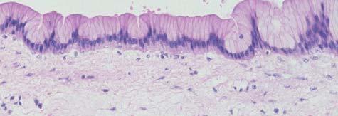 Pan IN (Pancreatic Intraepithelial Neoplasia) PanIN-1A-flat epithelium; basal nuclei,
