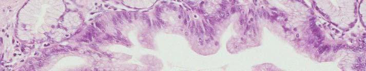 flat or papillary, micropapillary; some