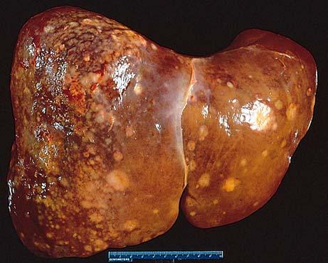 Tumors of the Liver Metastatic Cancer
