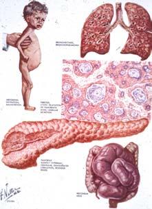 Pancreatic Cancer Often advanced at the