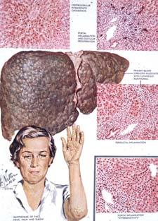 biliary tree Autoimmune, often leading to cirrhosis Sometimes associated with other