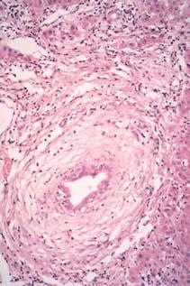 nature Primary Biliary Cirrhosis Primary Sclerosing Cholangitis Concentric fibrosis of