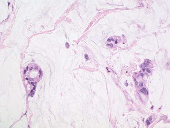 Perineural Invasion Colloid Carcinoma An infiltrating adenocarcinoma characterized by mucin producing