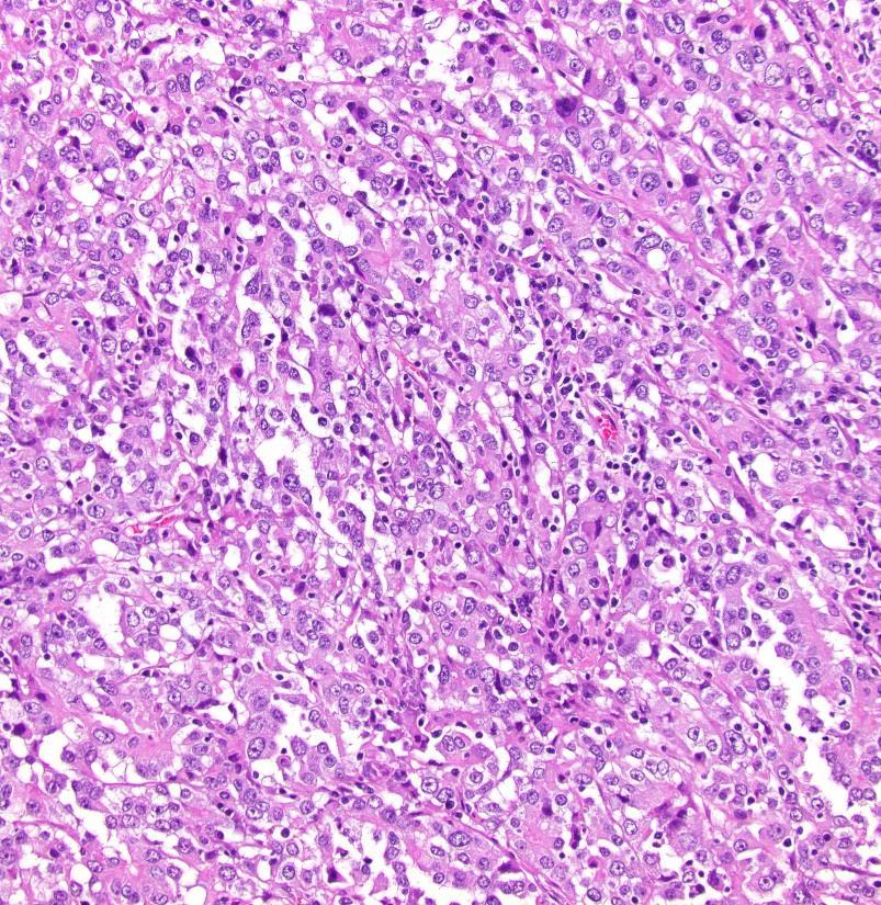 but not all, carcinomas with medullary histology have microsatellite instability Family history of