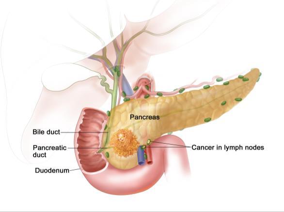and body/tail Anterior pancreaticoduodenal and proximal mesenteric Posterior pancreaticoduodenal and proximal mesenteric Pancreatic head/uncinate: stomach pylorus (infrapyloric and subpyloric),