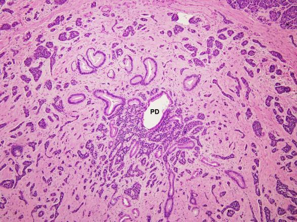 Differentiation Lung (Differentiation): Carcinoid and Atypical carcinoid