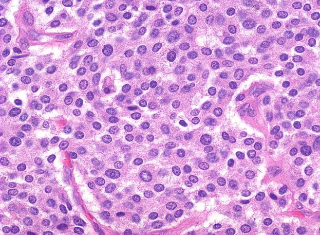 Carcinoid / Well-Differentiated Neuroendocrine Tumors Microscopic criteria: Various organoid histologic patterns: nesting, trabecular, glandular, gyriform, tubuloacinar or