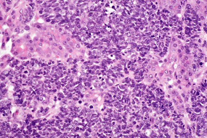 Poorly-Differentiated Neuroendocrine Carcinomas Microscopic subtypes: Small cell carcinoma Small