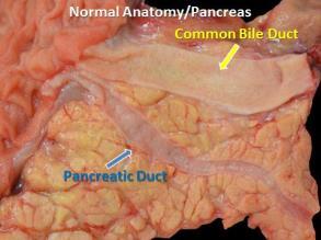 Adenocarcinoma Definition- invasive gland-forming epithelial neoplasm Clinical presentation- diagnosis late in the course Pathology- varies Precursor lesions- pancreatic intraepithelial neoplasia