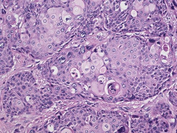 Colloid Carcinoma An infiltrating adenocarcinoma characterized by mucin producing neoplastic