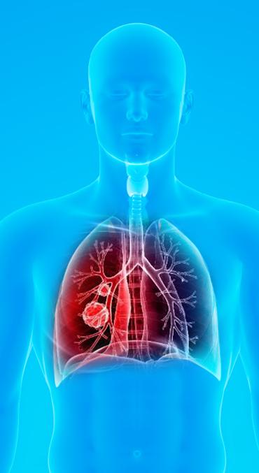 Detecting lung cancer early through connection to blood Typically takes >3 years for lung cancer to progress from