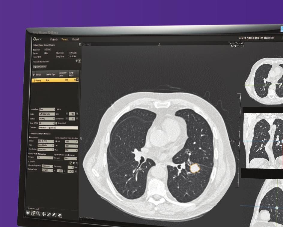 study continue to increase, the diligence required in finding small lung nodules among hundreds of CT image