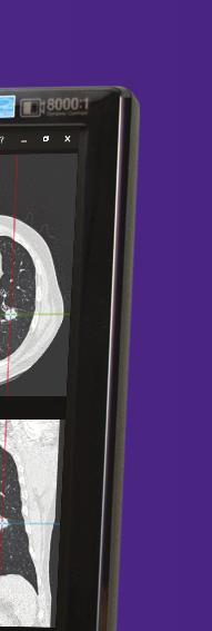 Oversight of actionable lung nodules on CT images is always a risk, however, new, innovative tools are