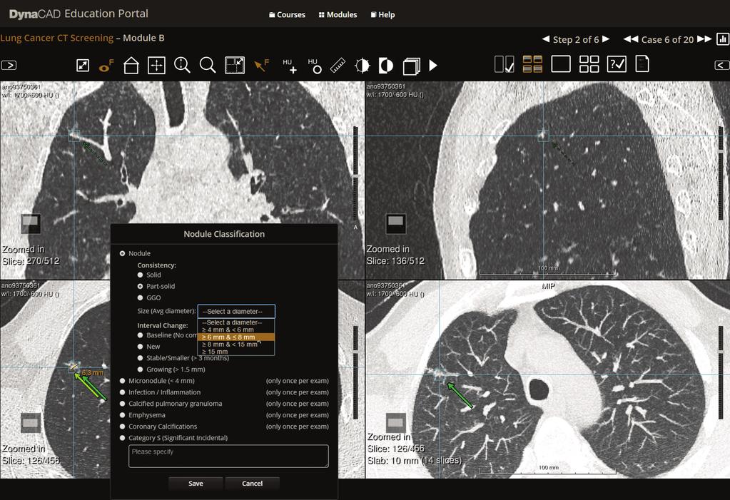 The DynaCAD Education Portal is an intuitive learning environment for testing physician proficiency in reading lung screening exams via a set of easy-to-use, web-based tools.