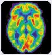 PET and Aging PET Scan of 20-Year-Old Brain PET Scan of