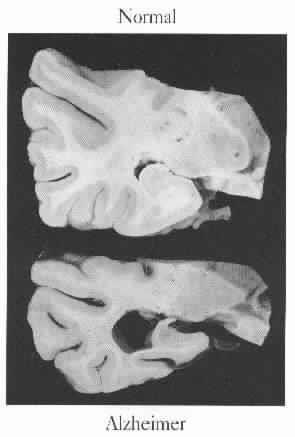 DEMENTIA Alzheimer s Disease Early onset Normal onset Vascular (Multiinfarct) Dementia Lewy Body Dementia Fronto- Temporal Lobe