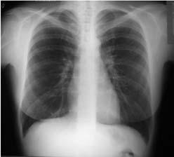 Fitzgerald Health Education Associates 14 Before Beginning the Interpretation Patient identification X-ray view PA, AP, lateral, decubitus Breath Inspiration or expiration X-ray penetration Under or