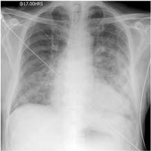Views of a Chest Radiograph (continued) Anterior-posterior (AP view) Used when the patient is unable to cooperate with a PA view (common with portable x-ray) Cassette is placed behind the patient