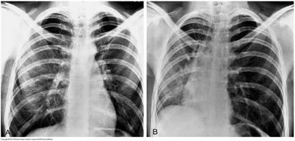 Technical Quality of the Radiograph Penetration The lower thoracic vertebrae should be visible through the heart The bronchovascular structures (behind the heart) should be seen Trachea Aortic arch