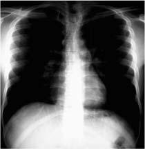 Under-penetration Over-penetration Dark Heart becomes radiolucent Less density in the lungs (appearance of lacking lung tissue) Vertebral discs are clearly seen Under-penetration Light Cardiac shadow