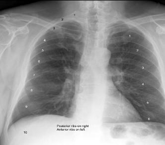 If more ribs are visible the patient is hyperinflated.