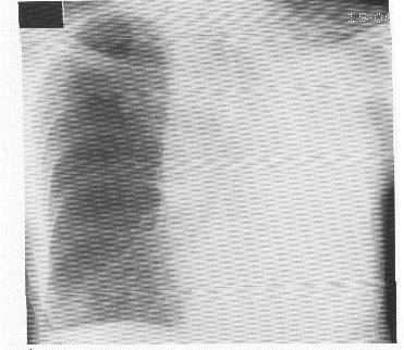 TB Lymphoma Leukemia Pulmonary hypertension Expiratory film Opaque hemithorax