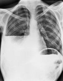 Pneumothorax. Pulmonary agenesis. Technical rotation.