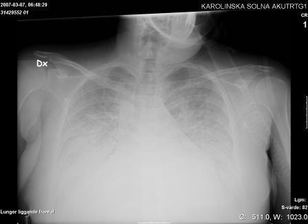 Postoperative chest x-ray May 2009 Mats Beckman Emergency