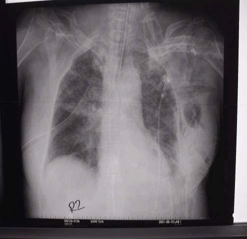 20Postoperative chest