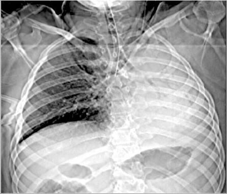 B-Breathing Chest X-ray reveals right bronchial intubation, a common finding in trauma patients