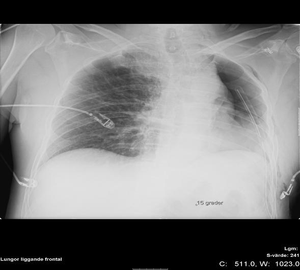 Lung resection Postop
