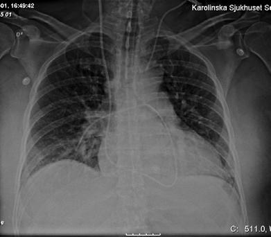 PA Catheter Pulmonary Artery