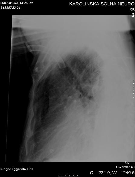 chest x-ray May