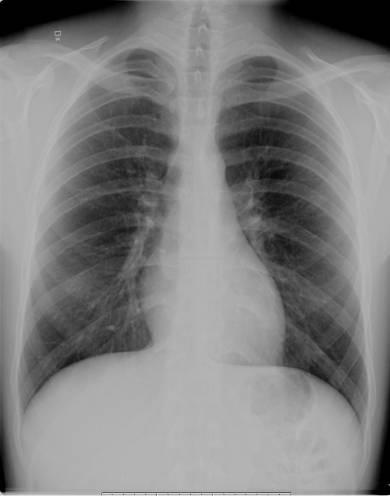 11Postoperative chest x-ray