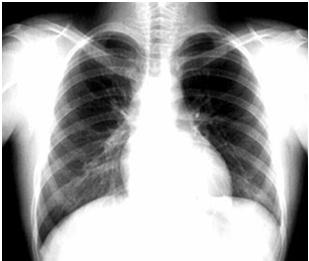 cardiovascular disease processes Recognize patterns of primary or metastatic carcinoma of the lung Recognize normal and abnormal placement of chest tubes and lines CXR Workshop This workshop will