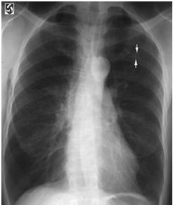 Lung Nodule Case Study #1 WB 75 yo male