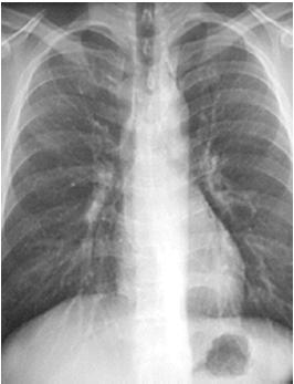 Step 1: Placement of CXR Verify the XR Name Date Position markers Type of CXR Patient History ex: