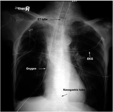 Normal Chest X ray ABC s of Reading a CXR A = Appliances and Airway B = Bones C = Circulation / Cardiac D = Diaphragm E = Everything Else Step 2: Airway and Appliances Airway