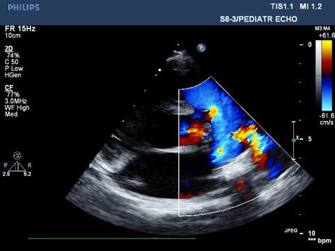 tubular ductus (figure 2). Ascending aortography was performed with 5 Fr pigtail catheter in the same view and the stenotic annulus demonstrated. The valve was crossed using a straight tip 0.