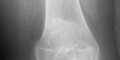 Osteoarthritis AP knee Medial joint