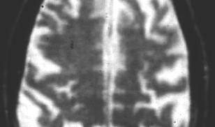 Brain Atrophy MRI T2 axial