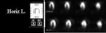 Sestamibi provides a snapshot of cardiac perfusion at the time of injection that persists Compare Stress and Rest