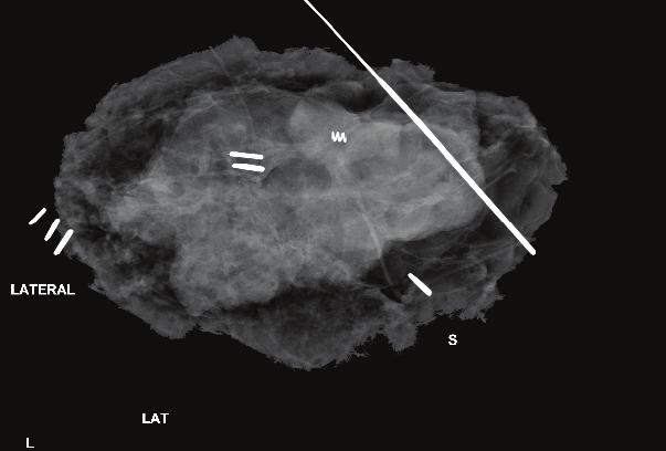 Figure 6: This specimen has a small spiculated lesion just inferior to the clip. Whereas the 2-D image only shows it as a density, fine spiculations can be clearly seen on the 3-D Tomo slice.
