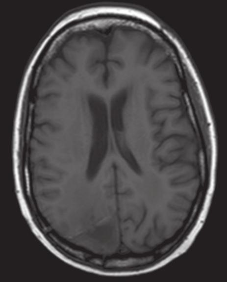 M M (a) (b) Fig. 1.11 MRI of the brain. (a) Axial T1-weighted image. (b) Axial T2-weighted image.