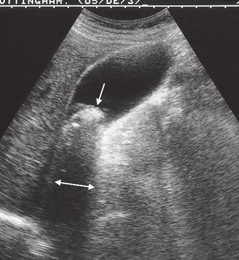6 Chapter 1 Fig. 1.7 Ultrasound scan of gall bladder showing a large stone in the neck of the gall bladder (downward pointing arrow). Note the acoustic shadow behind the stone (horizontal arrows).