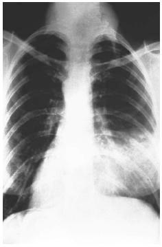 Endocarditis Tuberculosis Lupus