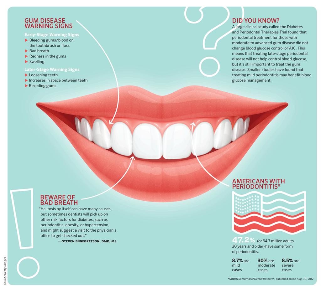 Signs and Symptoms of Periodontal Disease(gum disease) Puffy, swollen red gums Bleeding