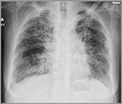 Stage IV Stage IV Development of pulmonary fibrosis Honeycombing and irreversible damage Often accompanied by development of pulmonary hypertension Respiratory