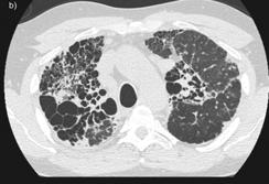 obstruction on spirometry Significant extrapulmonary disease Cardiac, liver, uveitis, hypercalcemia Not indicated in stage I or asymptomatic stage II Spontaneous